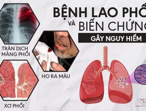 Bệnh lao phổi là gì