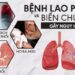 Bệnh lao phổi là gì