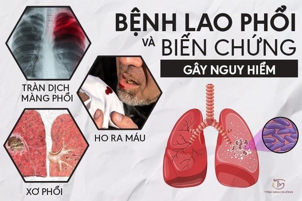 Bệnh lao phổi là gì