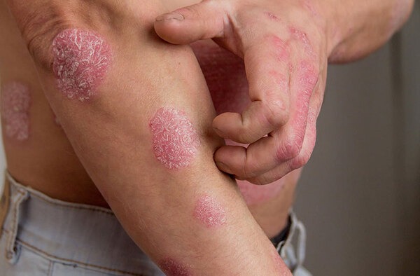 eczema