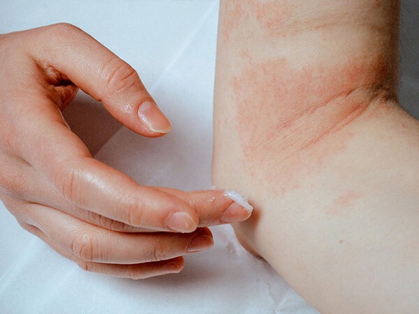 eczema