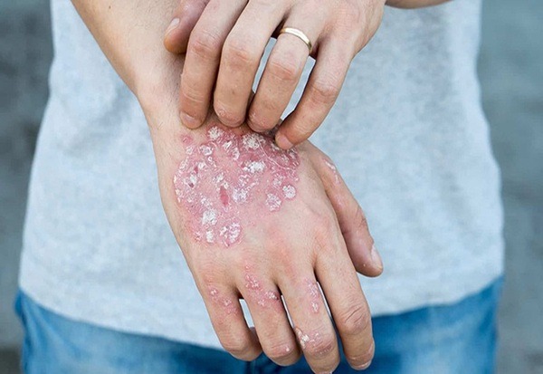 eczema là gì